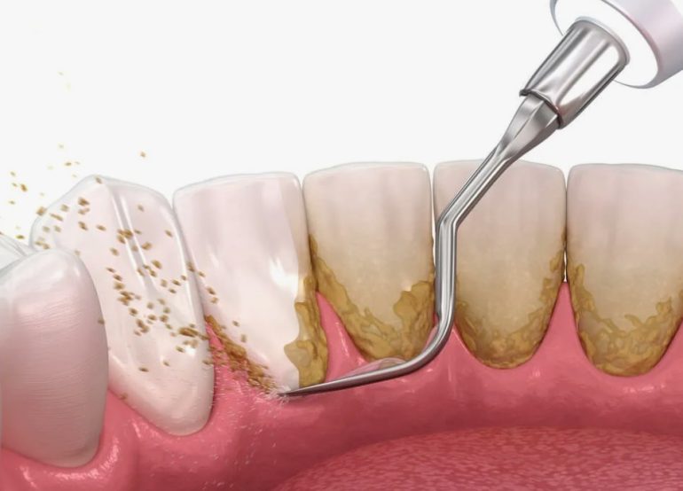 Как сохранить зубы здоровыми: профилактика и удаление зубного камня