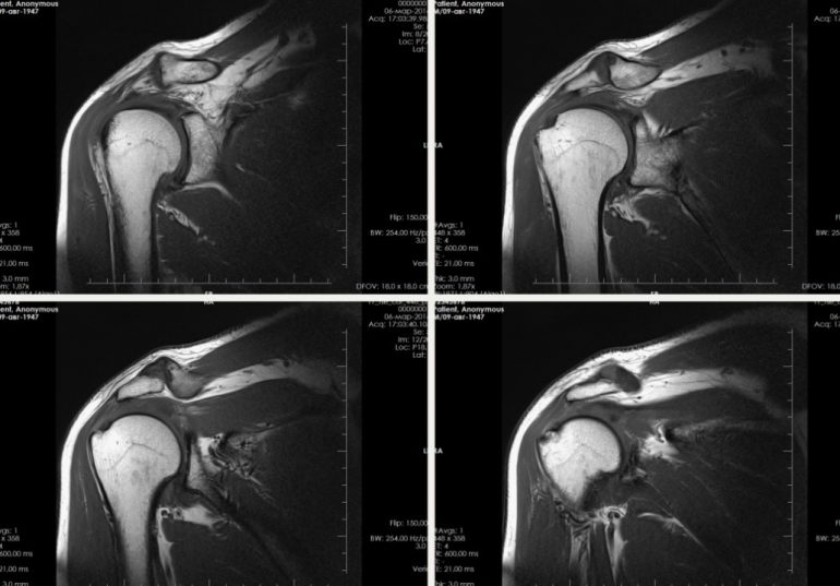 МРТ плечевого сустава: когда нужно делать и как подготовиться