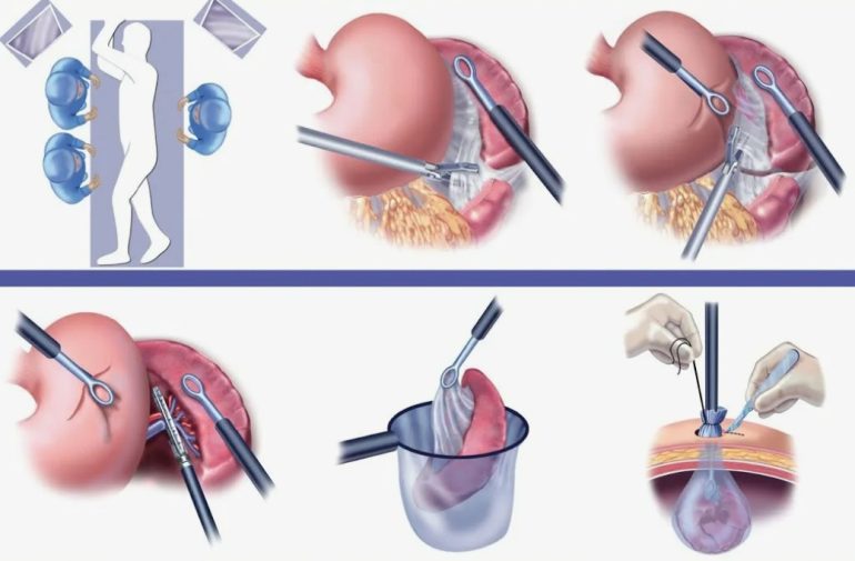 Почему проводится спленэктомия и что изменит операция